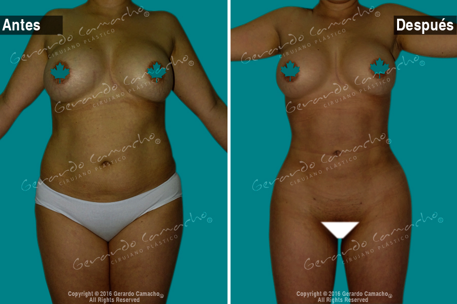 Testimonio lipolisis laser Bogota